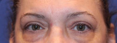 Blepharoplasty Before & After Gallery - Patient 211964 - Image 1