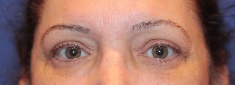 Blepharoplasty Before & After Gallery - Patient 211964 - Image 2