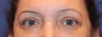 Blepharoplasty Before & After Gallery - Patient 211964 - Image 2