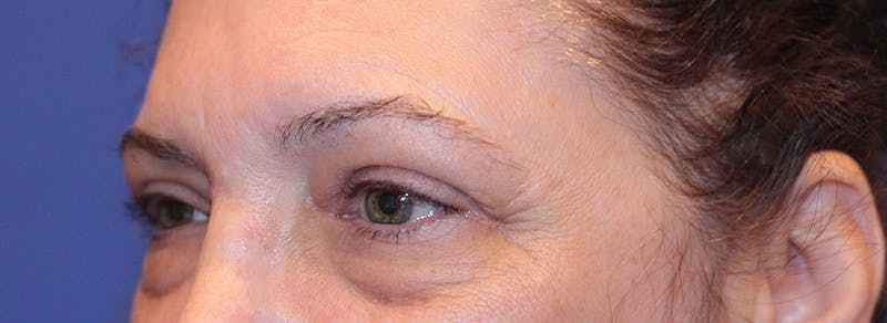 Blepharoplasty Before & After Gallery - Patient 211964 - Image 3
