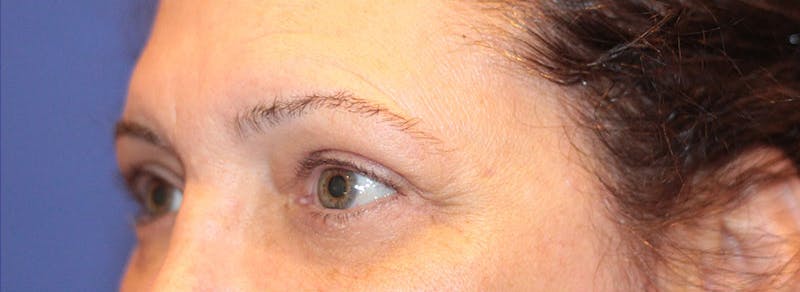 Blepharoplasty Before & After Gallery - Patient 211964 - Image 4