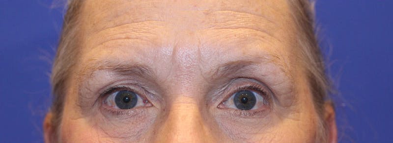 Blepharoplasty Before & After Gallery - Patient 369039 - Image 1