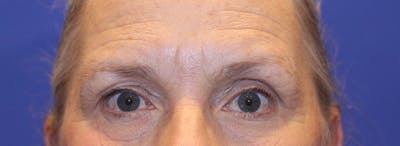 Blepharoplasty Before & After Gallery - Patient 369039 - Image 1