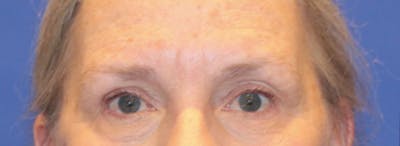 Blepharoplasty Before & After Gallery - Patient 369039 - Image 2