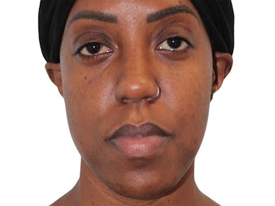 Buccal Fat Removal Before & After Gallery - Patient 263728 - Image 1