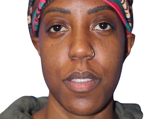 Buccal Fat Removal Before & After Gallery - Patient 263728 - Image 2