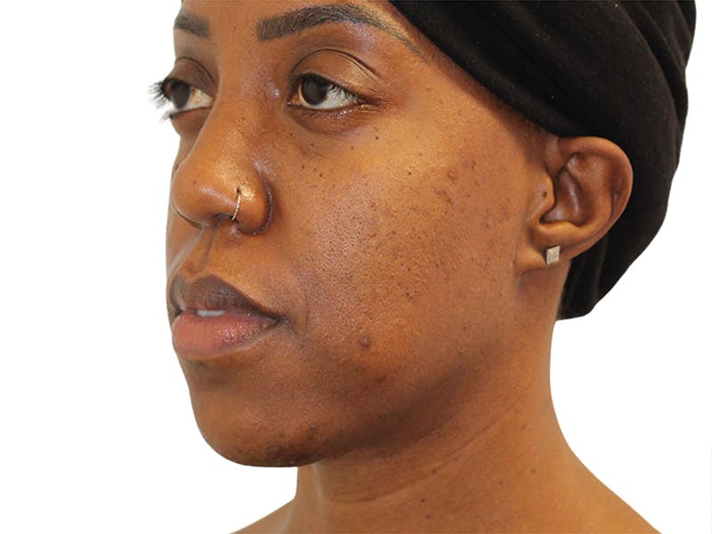 Buccal Fat Removal Before & After Gallery - Patient 263728 - Image 3