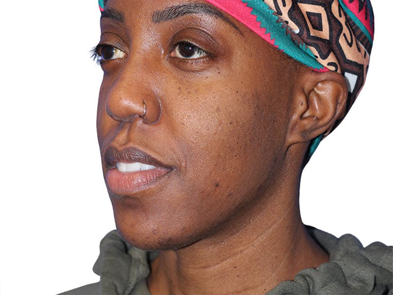 Buccal Fat Removal Before & After Gallery - Patient 263728 - Image 4