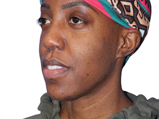 Buccal Fat Removal Before & After Gallery - Patient 263728 - Image 4