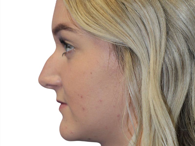 Rhinoplasty Before & After Gallery - Patient 693941 - Image 1