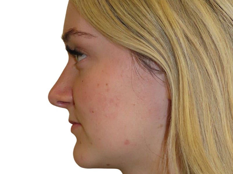 Rhinoplasty Before & After Gallery - Patient 693941 - Image 2
