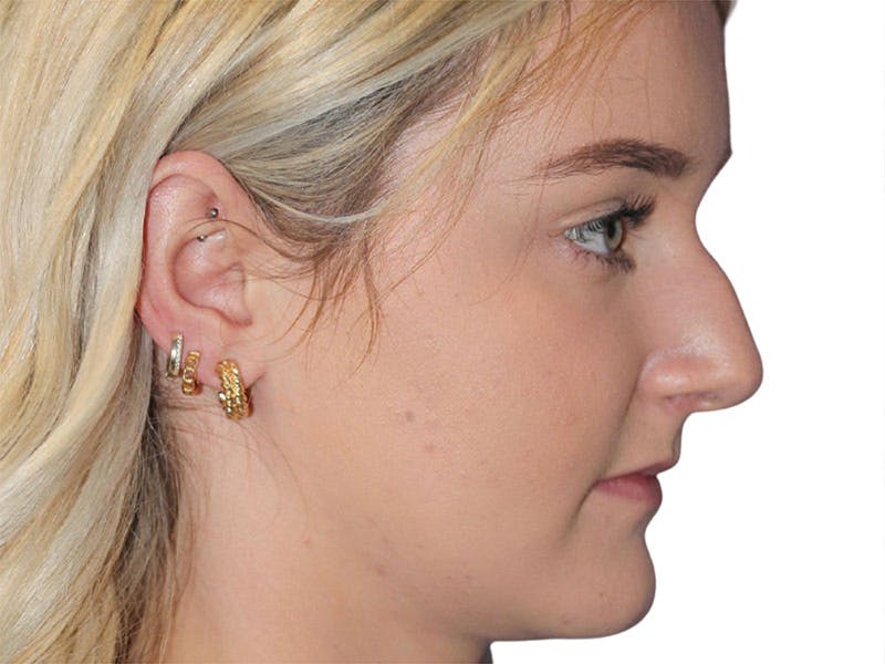 Rhinoplasty Before & After Gallery - Patient 693941 - Image 3