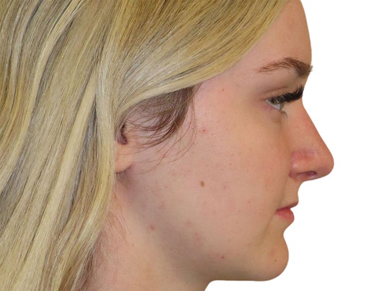 Rhinoplasty Before & After Gallery - Patient 693941 - Image 4