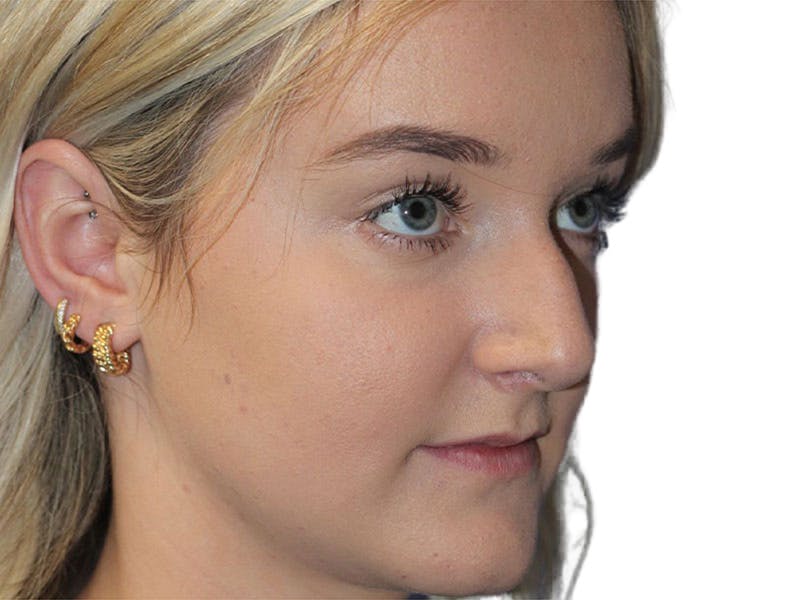 Rhinoplasty Before & After Gallery - Patient 693941 - Image 5