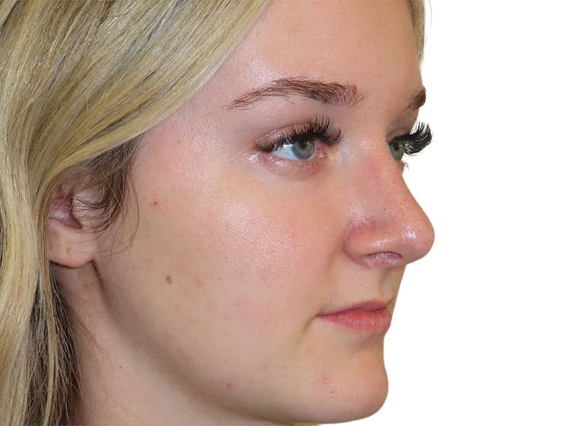 Rhinoplasty Before & After Gallery - Patient 693941 - Image 6