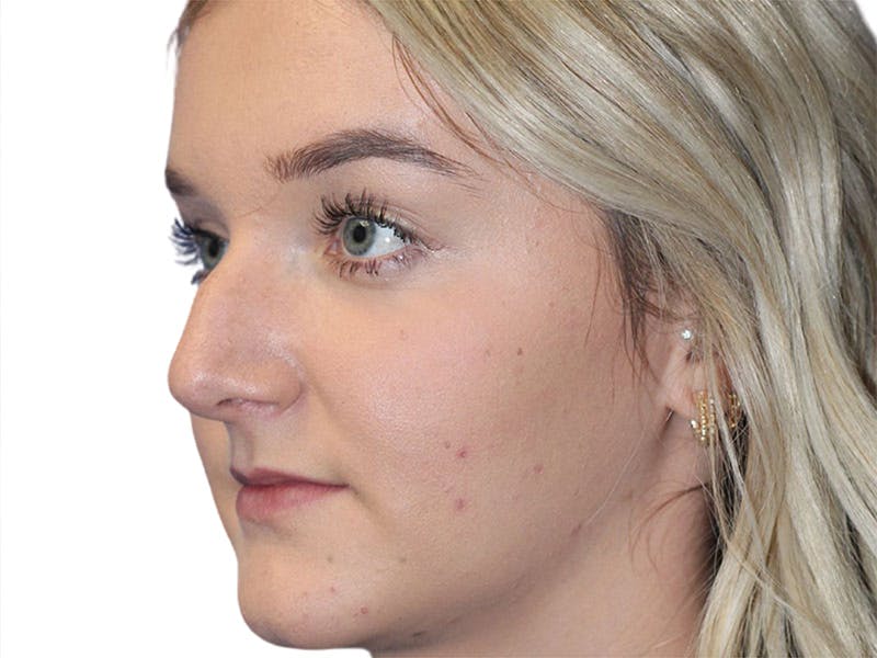 Rhinoplasty Before & After Gallery - Patient 693941 - Image 7