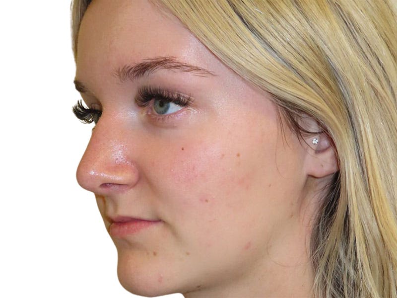 Rhinoplasty Before & After Gallery - Patient 693941 - Image 8