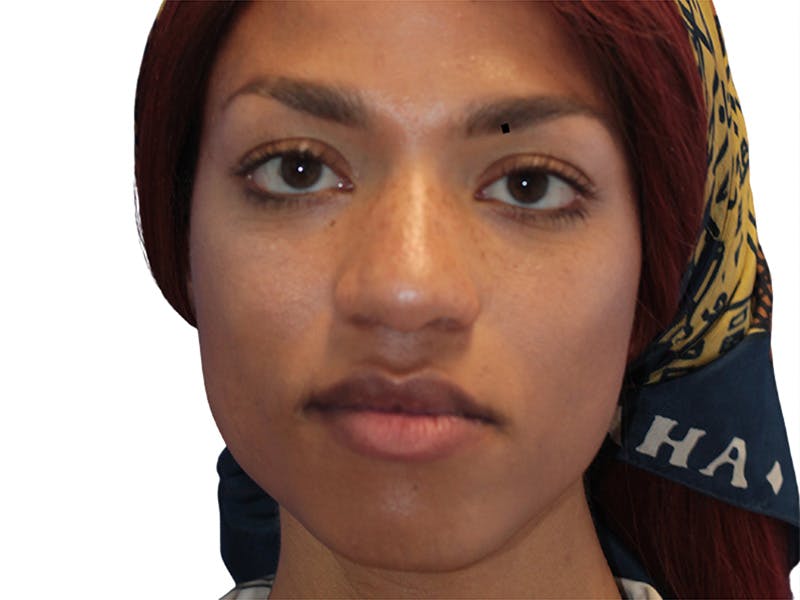Rhinoplasty Before & After Gallery - Patient 322882 - Image 1