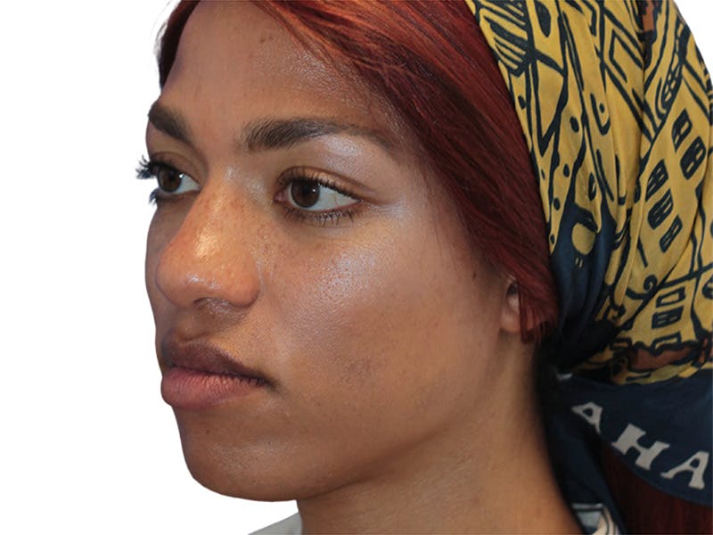 Rhinoplasty Before & After Gallery - Patient 322882 - Image 5