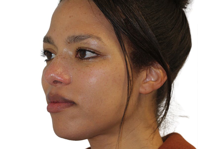 Rhinoplasty Before & After Gallery - Patient 322882 - Image 6