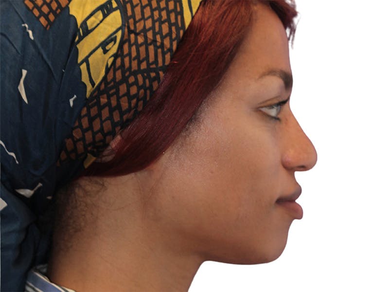 Rhinoplasty Before & After Gallery - Patient 322882 - Image 7