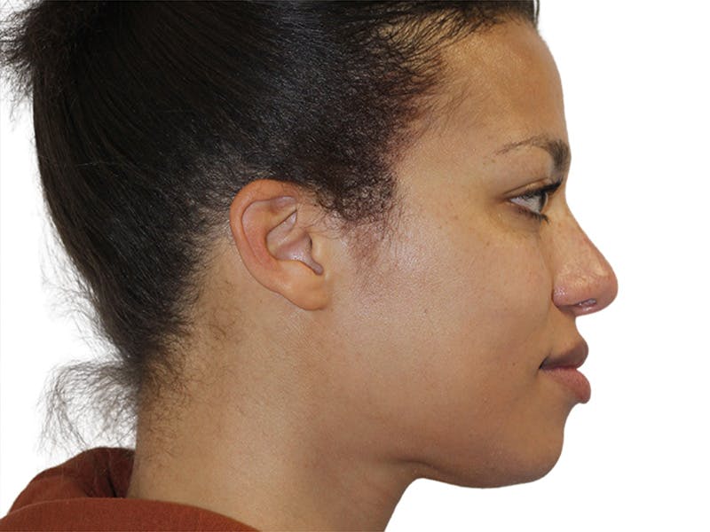 Rhinoplasty Before & After Gallery - Patient 322882 - Image 8