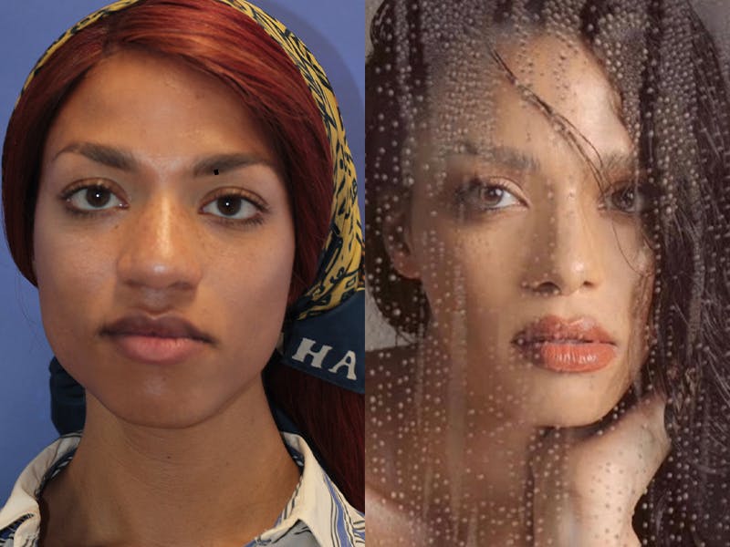 Facial Feminization Before & After Gallery - Patient 127806 - Image 7