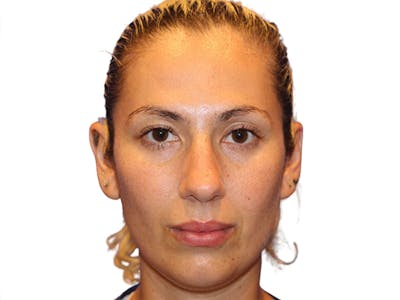 Rhinoplasty Before & After Gallery - Patient 288390 - Image 1