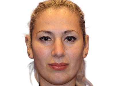 Rhinoplasty Before & After Gallery - Patient 288390 - Image 2