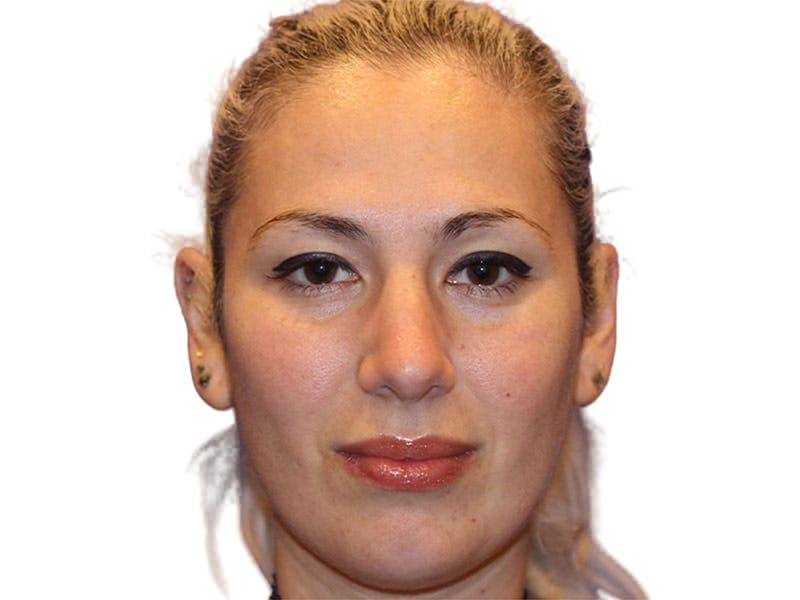 Rhinoplasty Before & After Gallery - Patient 288390 - Image 2