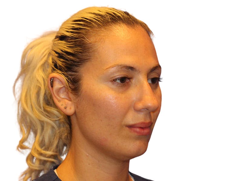 Rhinoplasty Before & After Gallery - Patient 288390 - Image 3