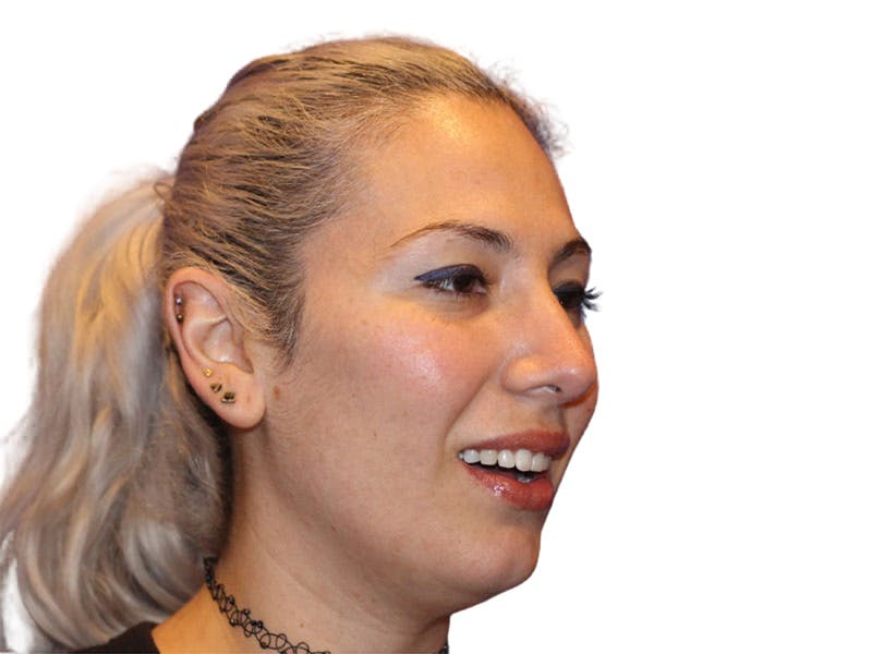 Rhinoplasty Before & After Gallery - Patient 288390 - Image 4