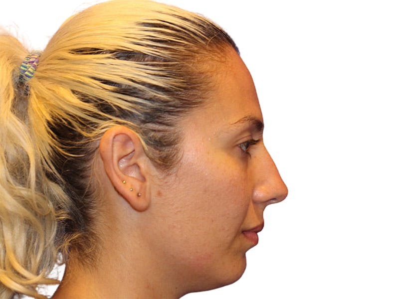 Rhinoplasty Before & After Gallery - Patient 288390 - Image 5