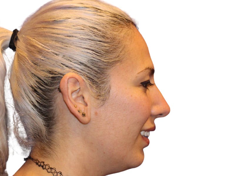 Rhinoplasty Before & After Gallery - Patient 288390 - Image 6