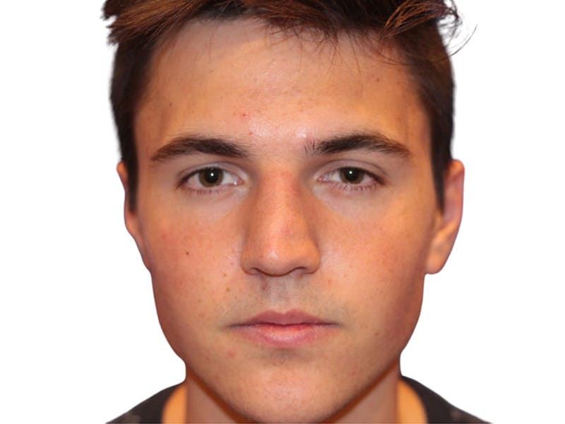 Rhinoplasty Before & After Gallery - Patient 366229 - Image 1