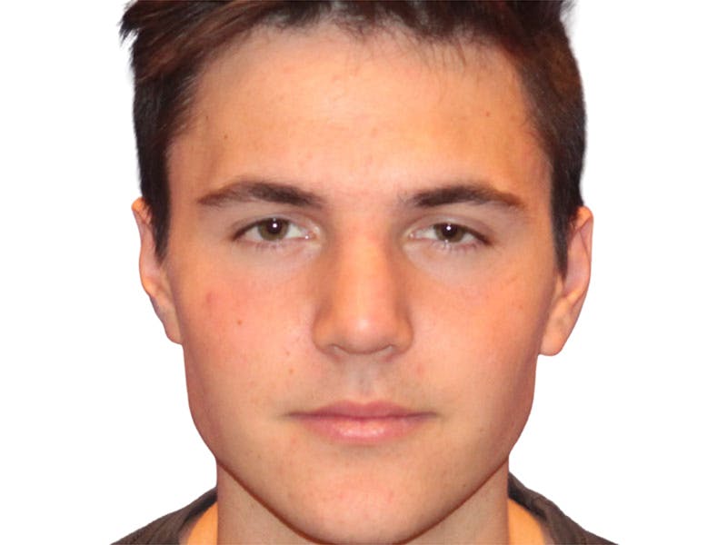 Rhinoplasty Before & After Gallery - Patient 366229 - Image 2