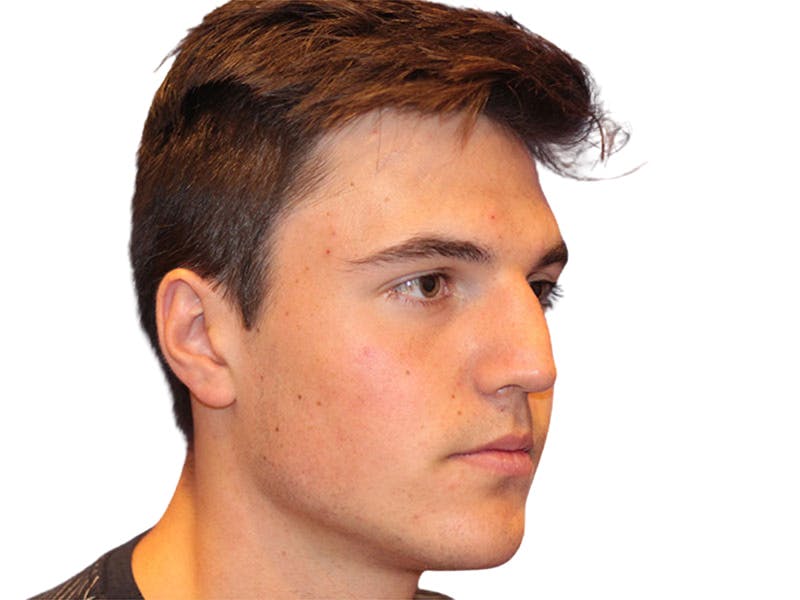 Rhinoplasty Before & After Gallery - Patient 366229 - Image 3