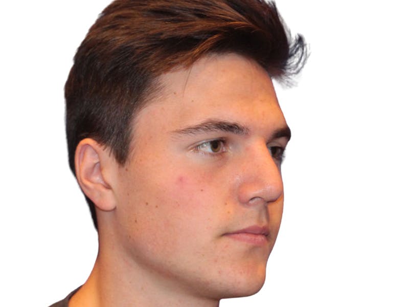 Rhinoplasty Before & After Gallery - Patient 366229 - Image 4