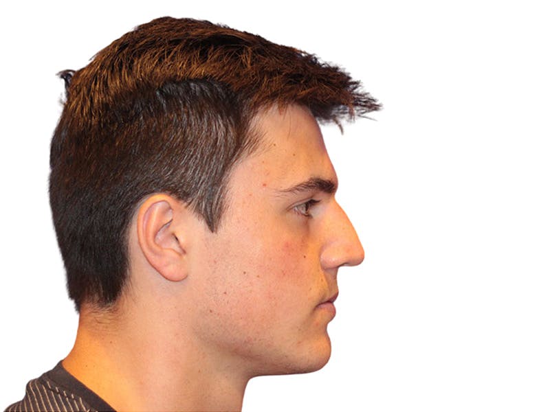 Rhinoplasty Before & After Gallery - Patient 366229 - Image 5