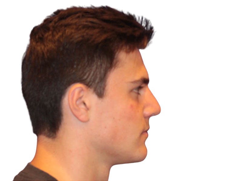 Rhinoplasty Before & After Gallery - Patient 366229 - Image 6