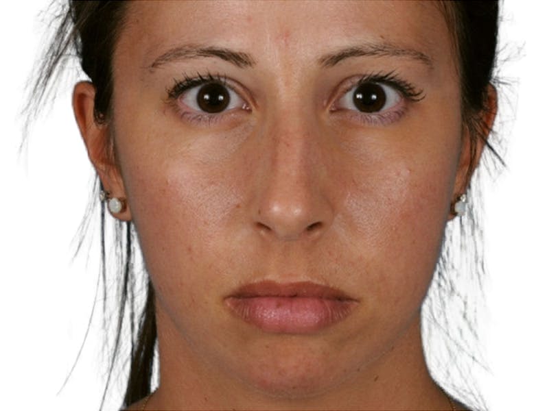 Rhinoplasty Before & After Gallery - Patient 469412 - Image 1