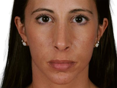 Rhinoplasty Before & After Gallery - Patient 469412 - Image 2