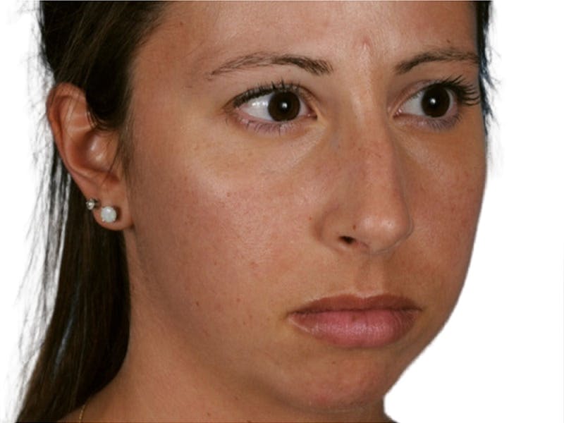 Rhinoplasty Before & After Gallery - Patient 469412 - Image 3
