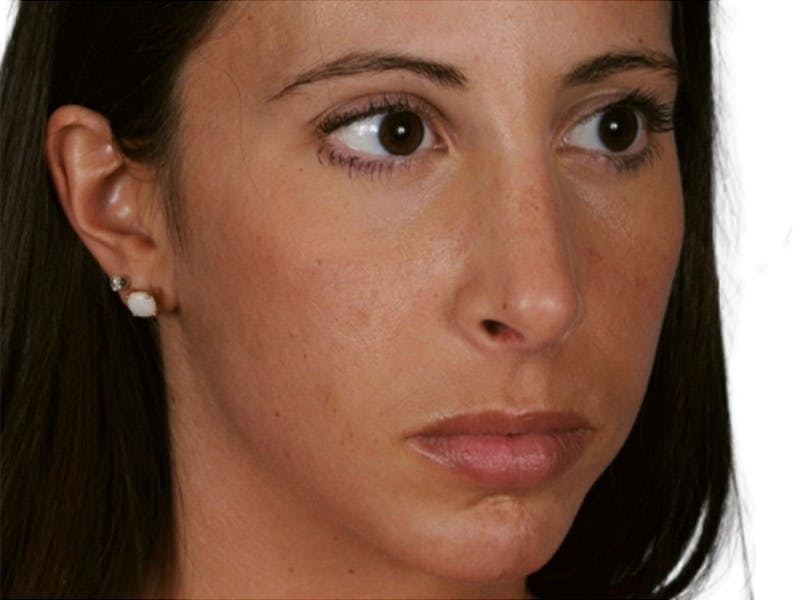 Rhinoplasty Before & After Gallery - Patient 469412 - Image 4