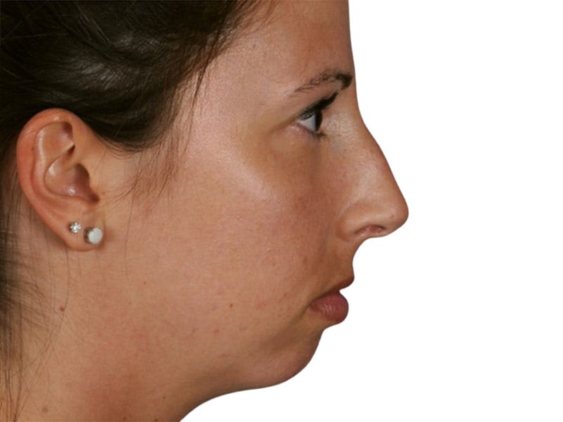 Rhinoplasty Before & After Gallery - Patient 469412 - Image 5