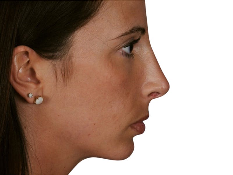 Rhinoplasty Before & After Gallery - Patient 469412 - Image 6