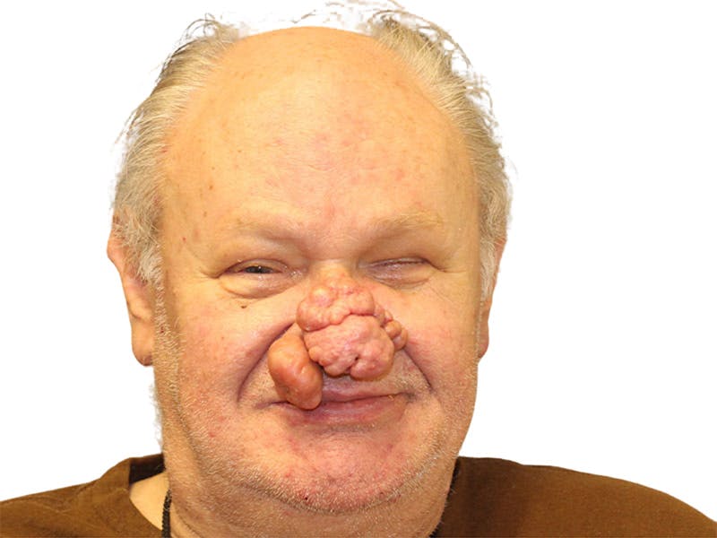 Rhinoplasty Before & After Gallery - Patient 417628 - Image 1