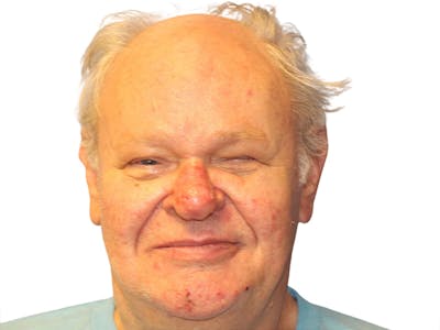 Rhinoplasty Before & After Gallery - Patient 417628 - Image 2