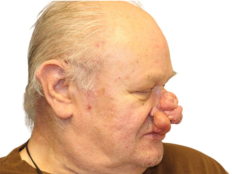Rhinoplasty Before & After Gallery - Patient 417628 - Image 3