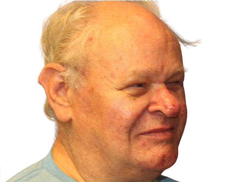 Rhinoplasty Before & After Gallery - Patient 417628 - Image 4